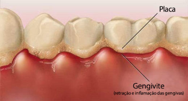 Placa Bacteriana