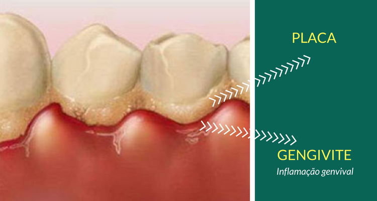 Periodontia e gengivite