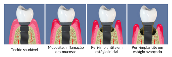 Estágios da Peri-implantite