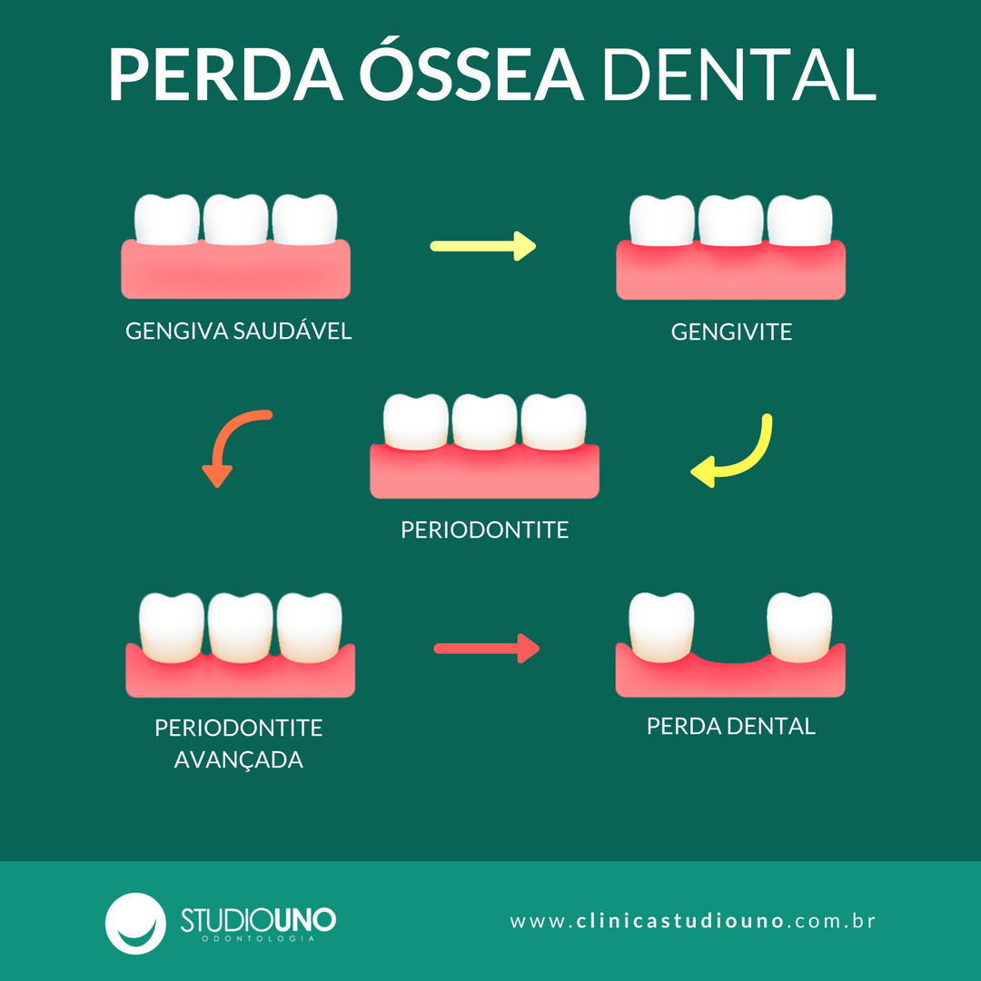 Processo de perda óssea dental