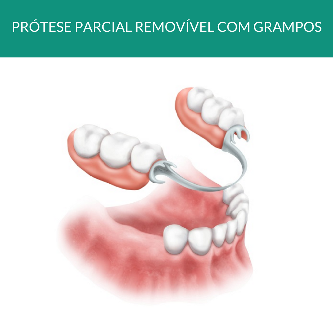 Prótese removível com grampos