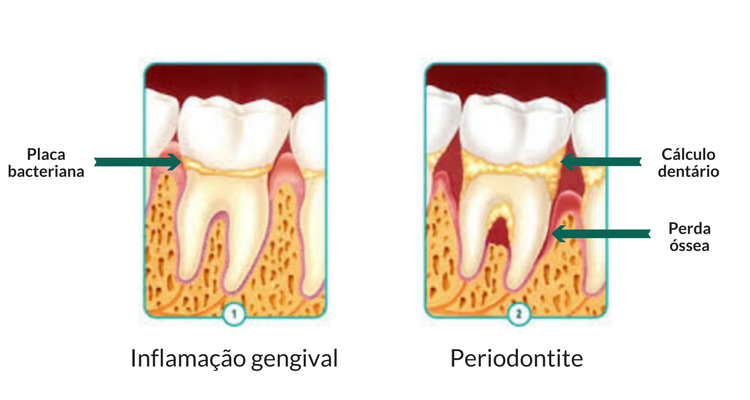 Tártaro e Cálculo dentário - Periodontia