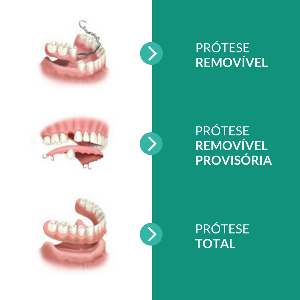 Tipos de próteses removíveis