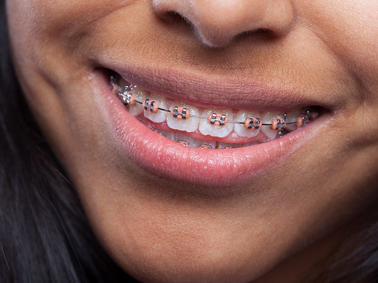 Tenho piercing na língua, posso colocar aparelho nos dentes?