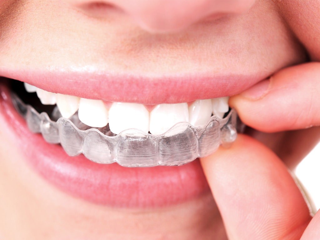 Invisalign Aparelho Invisível - Ortodontia - Clínica Odontológica StudoUno - Brasília-DF