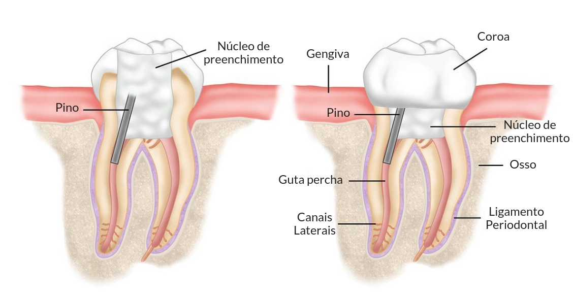 Anatomia dentária de um dente com pino - StudioUno Odontologia - Brasília/DF