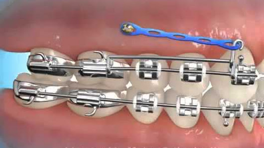 Mini-implante - Ortodontia - Clínica Odontológica StudoUno - Brasília-DF