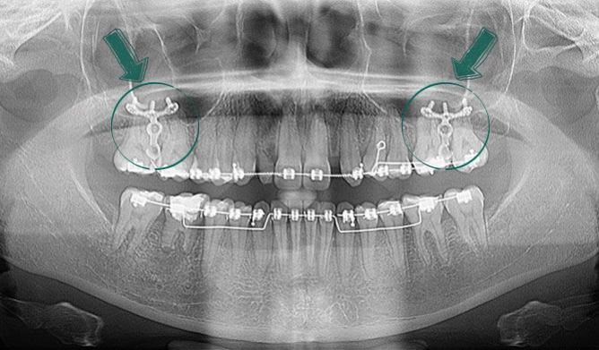 Miniplaca - Ortodontia - Clínica Odontológica StudoUn