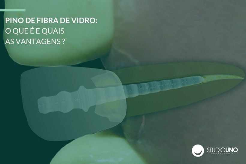 Pino de fibra de vidro: o que é e quais as vantagens? - StudioUno Odontologia - Brasília/DF