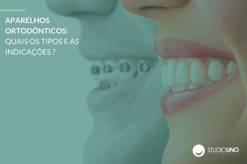 Aparelho Ortodônticos - Tipos e Indicações - StudioUno Odontologia - Brasília/DF