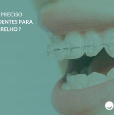 Pode ser preciso extrair dentes para usar aparelho?