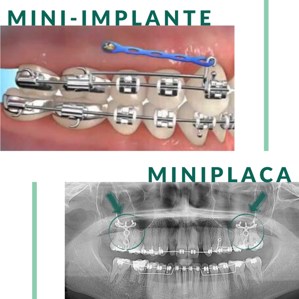 Como é feito o tratamento ortodôntico com implante dentário