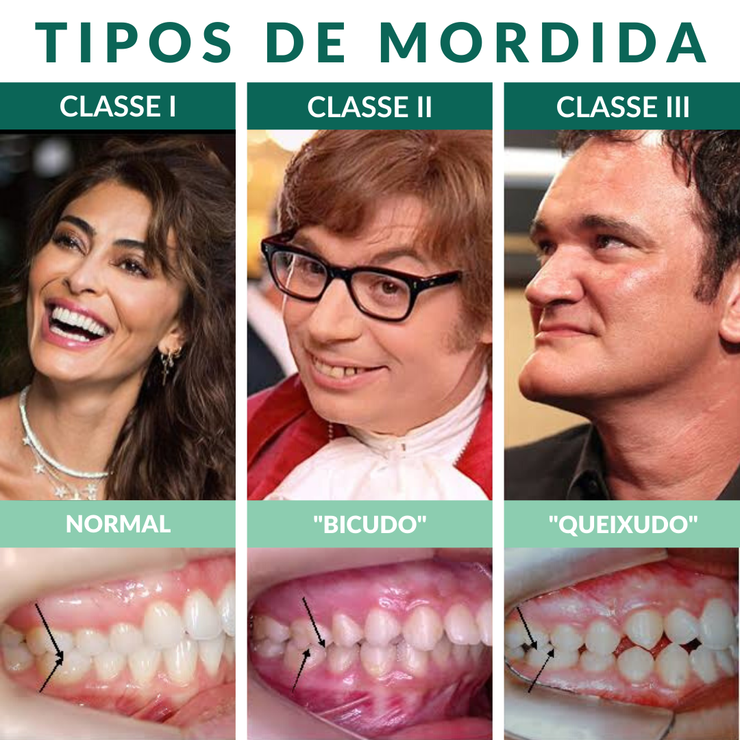 Pode ser preciso extrair dentes para