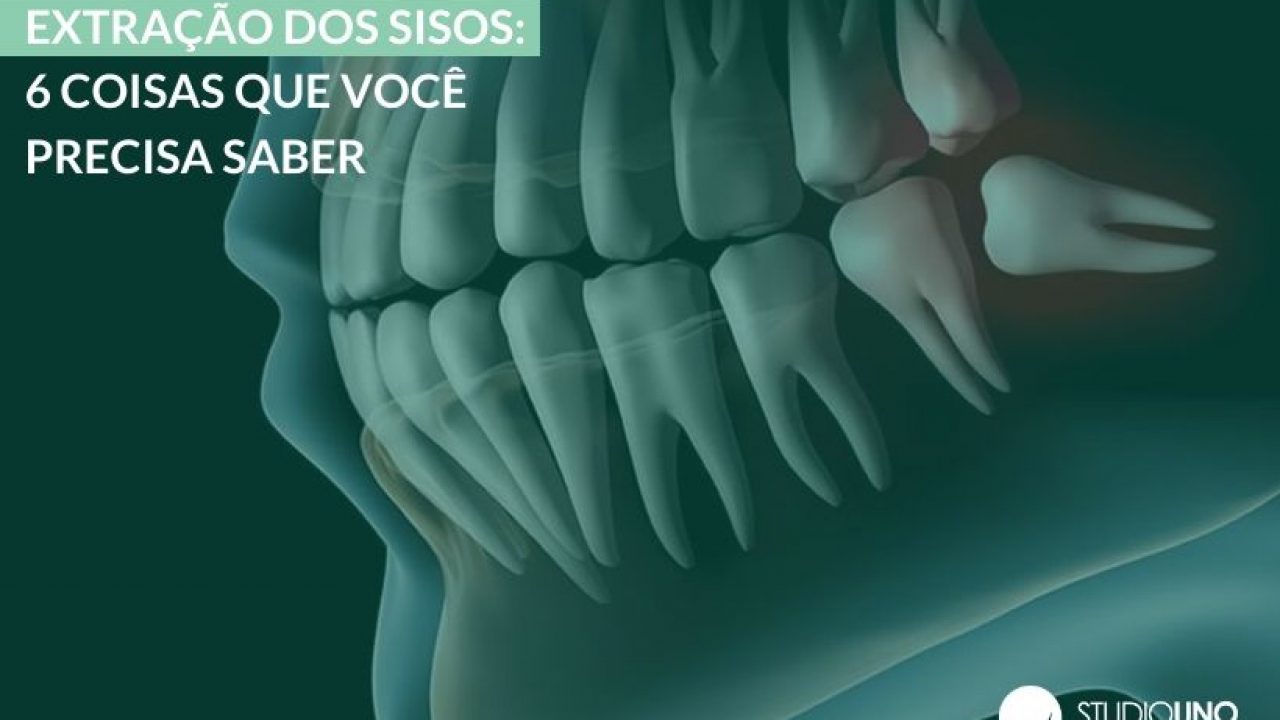 Extração dos sisos: 6 coisas que você precisa saber - StudioUno Odontologia