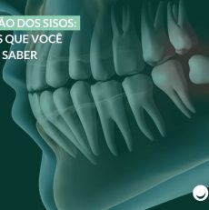 Extração dos sisos: 6 coisas que você precisa saber