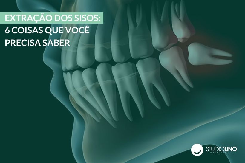Extração dos sisos: 6 coisas que você precisa saber - StudioUno Odontologia - Brasília/DF