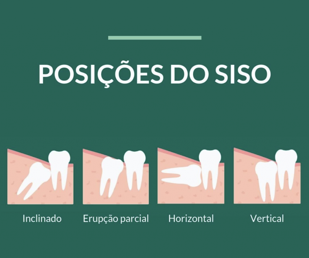 Posições do siso - StudioUno Odontologia - Brasília/DF