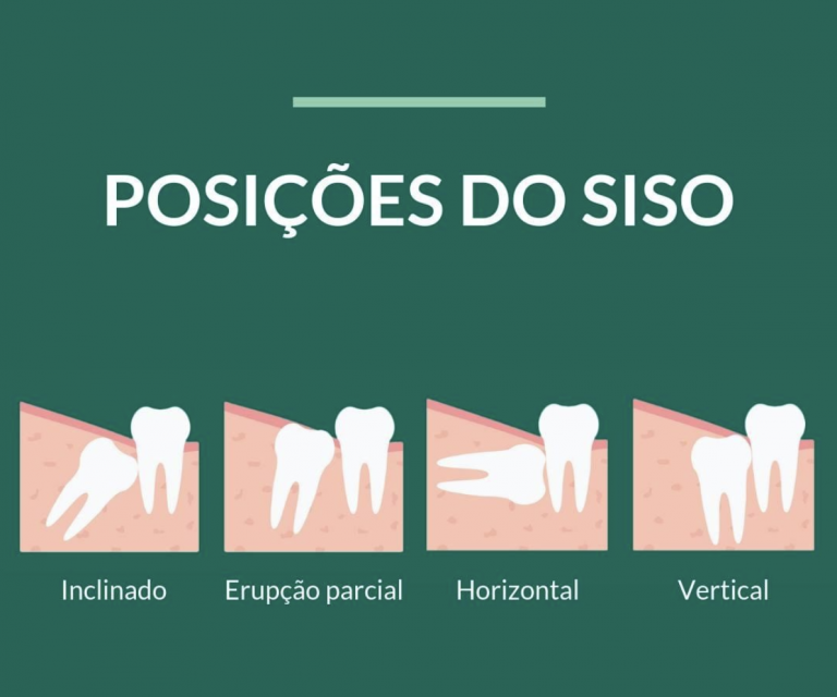 Extração dos sisos 6 coisas que você precisa saber StudioUno Odontologia