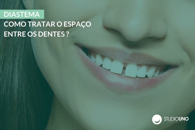 Diastema: como tratar o espaço entre os dentes? - StudioUno Odontologia - Brasília/DF