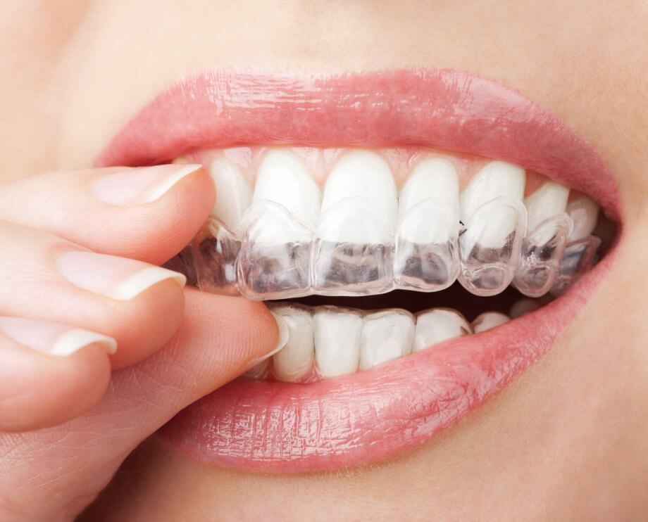 O tratamento ortodôntico #invisalign é livre de fios e bráquetes. Liberte o  seu sorriso! Com Invisalign…