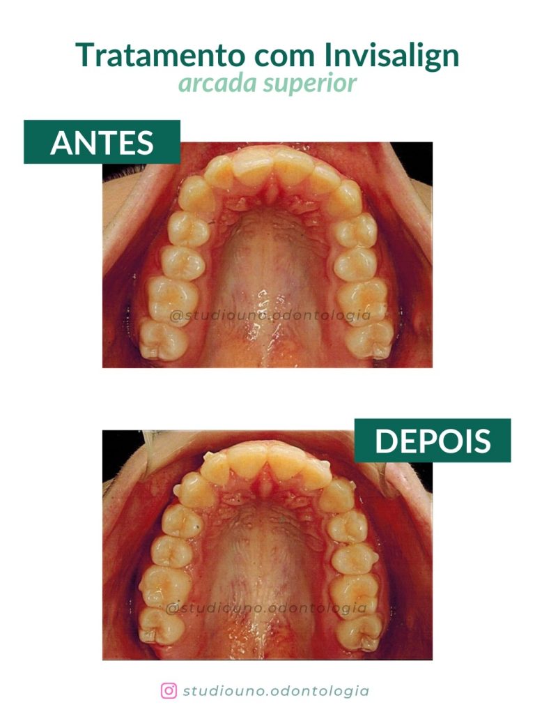 Tratamento na arcada superior com o aparelho Invisalign - Brasília - DF