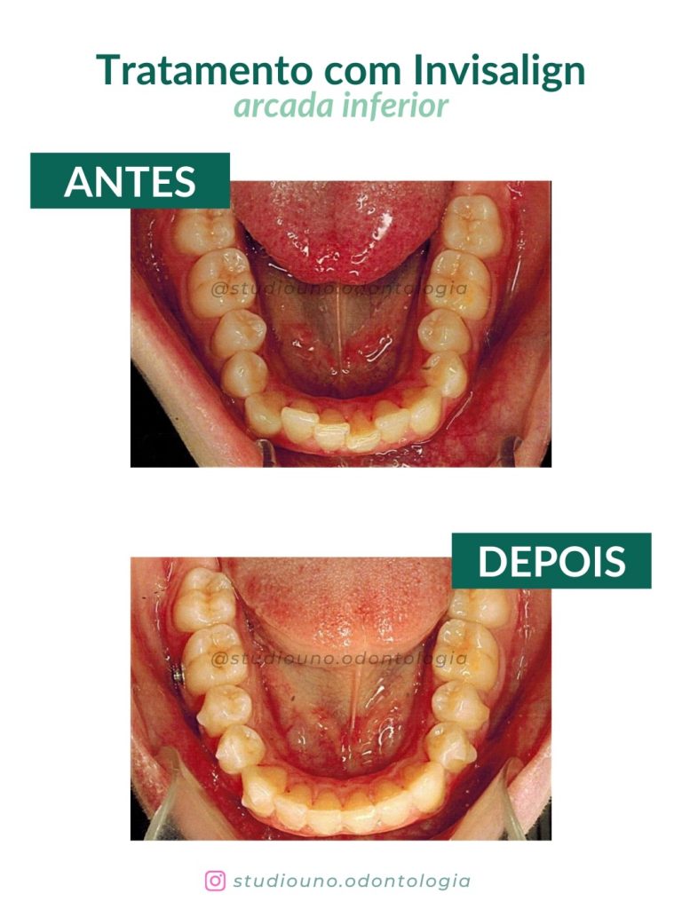 Invisalign em Brasília: melhore seu sorriso com o aparelho