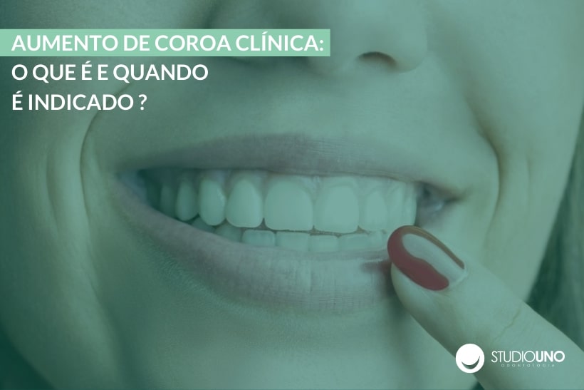 Aumento de coroa clínica - StudioUno Odontologia Brasília DF