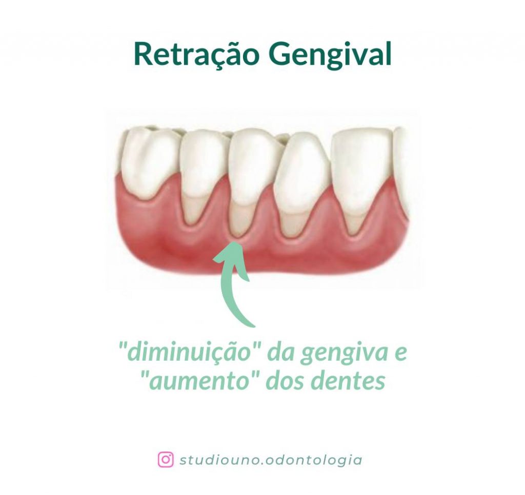 Retração gengival é a diminuição da gengiva | StudioUno Odontologia Brasília DF