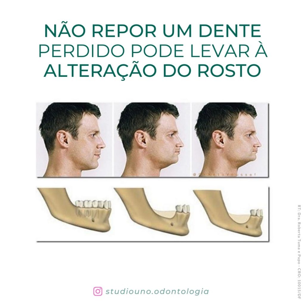 Não repor um dente perdido pode levar à alteração do rosto | StudioUno Odontologia Brasília DF