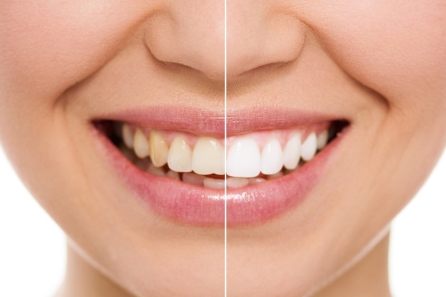 Como resolver os dentes amarelos | StudioUno Odontologia Brasília DF