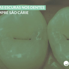 Manchas escuras nos dentes nem sempre são cárie