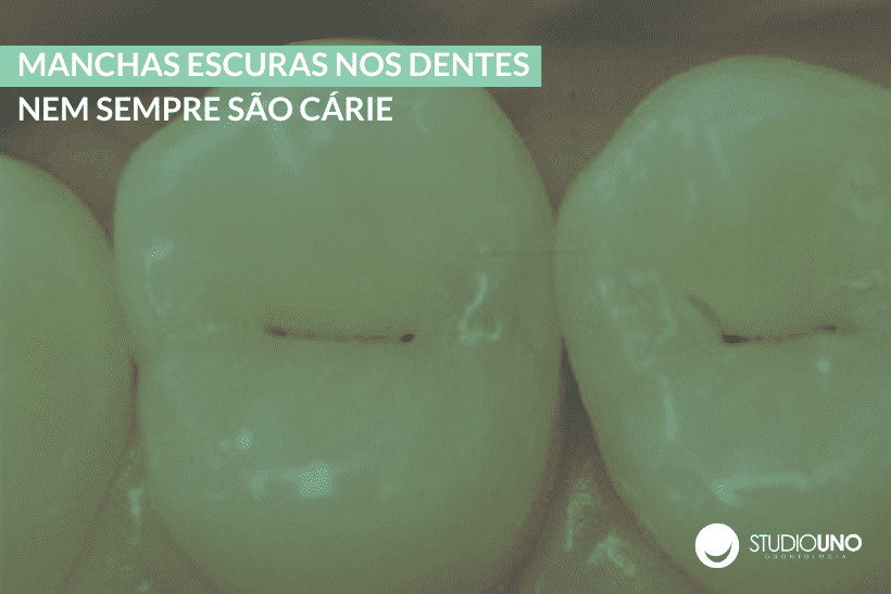 Manchas escuras nos dentes nem sempre são cárie | StudioUno Odontologia Brasília DF